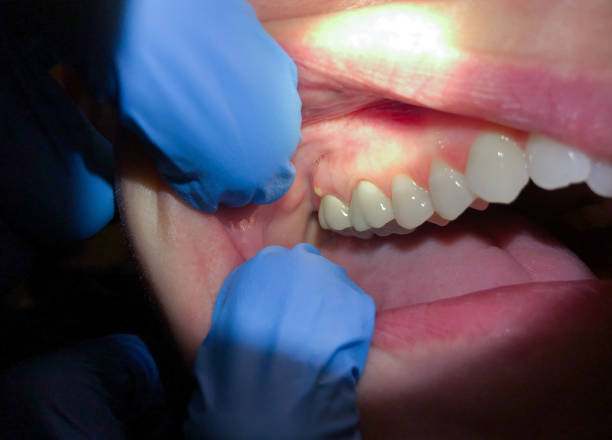 Best Emergency Root Canal Treatment in Swansboro, NC